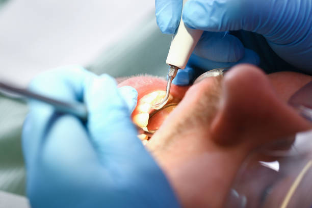 Best Emergency Root Canal Treatment in East Griffin, GA
