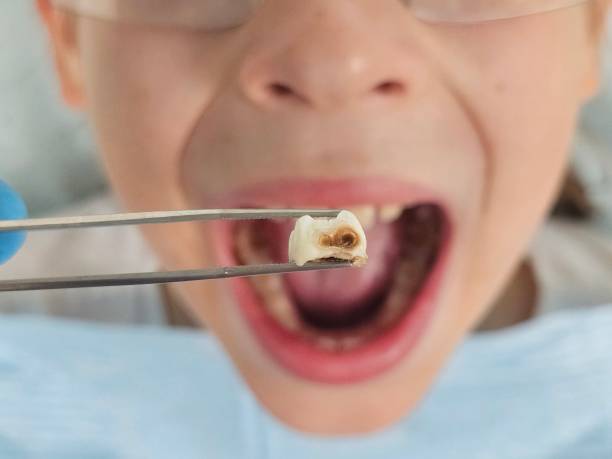 Best Urgent Care for Lost Fillings or Crowns in East Griffin, GA